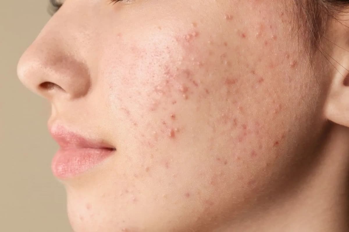 Acne Treatment